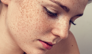 Bí quyết ngăn ngừa tăng sắc tố da vào ngày hè, chị em nên lưu tâm để “phòng hơn chữa”