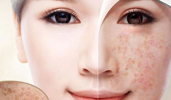 Nám da mặt lâu năm có cách nào chữa tận gốc được không?