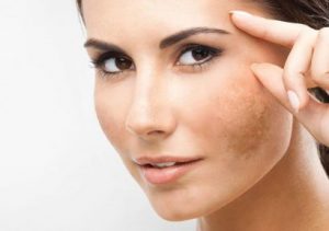 Nám da mặt lâu năm có cách nào chữa tận gốc được không?